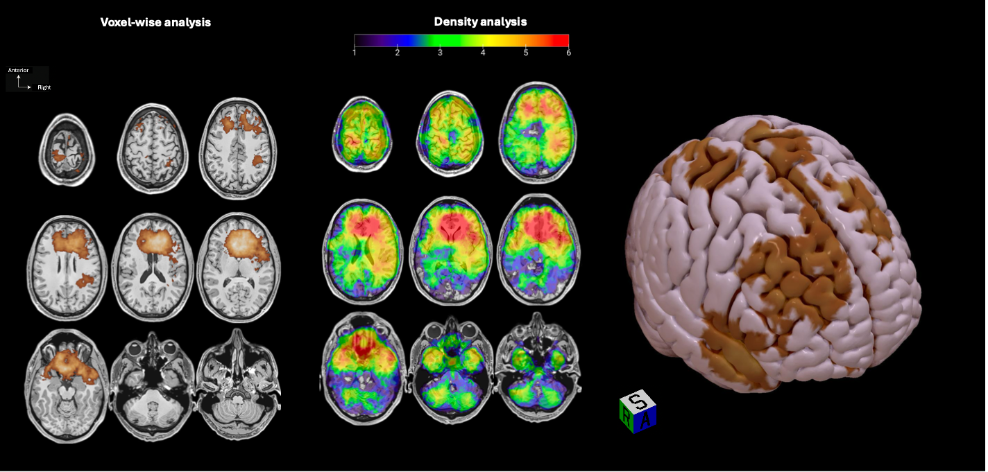 Cartes IRM probabilistes pour la présentation et la prise en charge des méningiomes intracrâniens