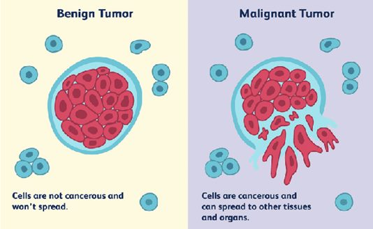 Tumeur bénigne versus tumeur maligne : jargon médical AMAVEA